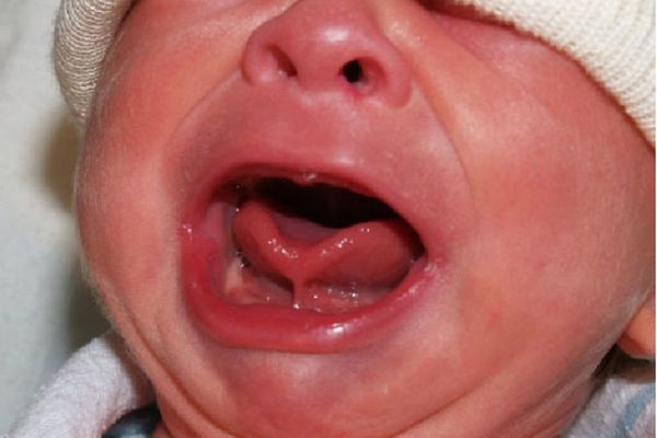 Tounge Tie? Apa Itu dan Cara Menaganinya